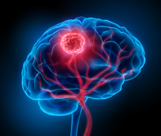 Brain tumor treatment and the question of homeopathic medicine, reviewed by a neurosurgeon